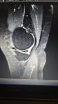 Лфк при частичном разрыве пкс коленного сустава и медиального мениска фото 5