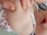Красное сухое пятно на руке ребенка фото 1