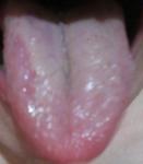 Пятна на языке от зубной пасты фото 1