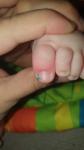 Воспаление на большом пальце у ребёнка фото 1
