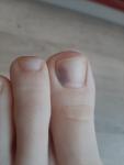 Почему потемнение на ногте большого пальца становится больше фото 1