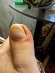 Покраснение вокруг большого пальца на ноге фото 1