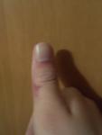 Ушиб или перелом большого пальца руки фото 3
