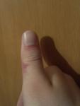 Ушиб или перелом большого пальца руки фото 2