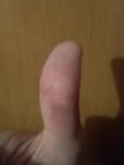 Ушиб или перелом большого пальца руки фото 1
