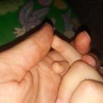 Водянистые волдырики на пальцах руки фото 3
