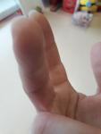 Множество мелких пузырьков между пальцами руки фото 3
