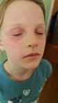 Пищевая аллергия у девочки 9 лет фото 2