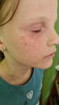 Пищевая аллергия у девочки 9 лет фото 3