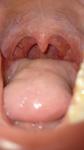 Болит горло (хр. Тонзилит) фото 2