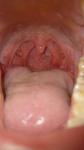 Болит горло (хр. Тонзилит) фото 1