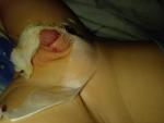 У ребенка после обрезания сильная краснота фото 2