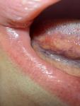 Рак языка красное пятно на языке фото 1