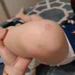 Пятна на ноге у ребенка во время лечения вирусной инфекции фото 1