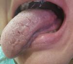 Следы от зубов на языке, боль, язва, жжение фото 2