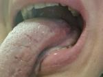 Следы от зубов на языке, боль, язва, жжение фото 3