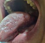 Следы от зубов на языке, боль, язва, жжение фото 1
