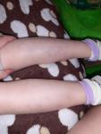 Гематомы на ногах у девочки 5 лет фото 3