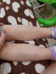Гематомы на ногах у девочки 5 лет фото 1