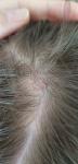 Розовое пятно, на волосистой части головы у ребенка 7 лет фото 3