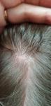 Розовое пятно, на волосистой части головы у ребенка 7 лет фото 4