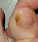 Меланома ли это большого пальца на ноге? фото 1
