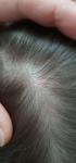 Розовое пятно, на волосистой части головы у ребенка 7 лет фото 1