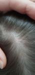 Розовое пятно, на волосистой части головы у ребенка 7 лет фото 2