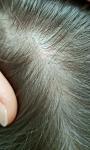 Розовое пятно, на волосистой части головы у ребенка 7 лет фото 5