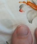 Появилось пятно на ногте большого пальца ноги фото 2