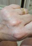 Проблема с кожей. Шелушение на кисти руках и розовые пятна фото 1