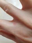 Розовое пятно между пальцами руки фото 2