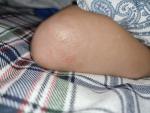 Сыпь на локтях у ребёнка прозрачные и красные волдырики фото 3