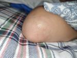 Сыпь на локтях у ребёнка прозрачные и красные волдырики фото 2