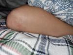 Сыпь на локтях у ребёнка прозрачные и красные волдырики фото 1