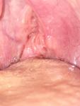 Проблемы с горлом и миндалины фото 3