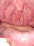 Проблемы с горлом и миндалины фото 1