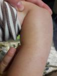 Сыпь на руках у ребенка уже 3 месяца фото 3