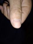 Основные симптомы, это маленькие точки на большом пальце руки фото 1