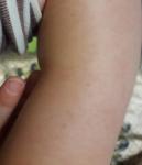 Сыпь на руках у ребенка уже 3 месяца фото 2