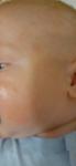 Сыпь на теле у ребенка 3 месяца фото 3