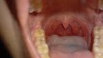 Болит горло (хр. Тонзиллит) фото 3