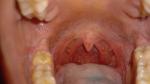 Болит горло (хр. Тонзиллит) фото 2