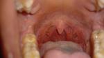 Болит горло (хр. Тонзиллит) фото 1