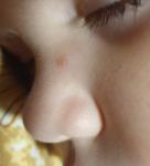 На носу у ребенка появилось круглое пятнышко фото 1