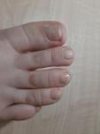 Грибок ногтей пальцев ног фото 1
