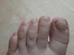Грибок ногтей пальцев ног фото 2
