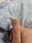 Полоса светло коричневого цвета на ногте большого пальца правой руки фото 1