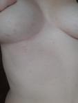 Красная сыпь на груди и животе фото 1