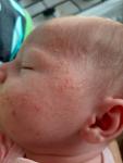Высыпания на лице новорожденного фото 2